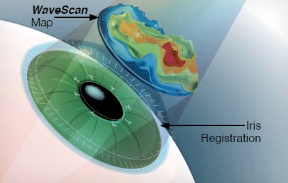 Stock image of illustration of laser treatment to eye