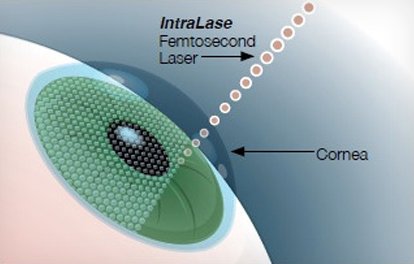 Stock image of illustration of laser treatment to eye