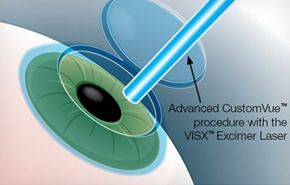 Stock image of illustration of laser treatment to eye