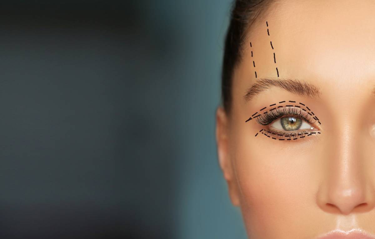 Lines on woman's face preparing for eyelid surgery.