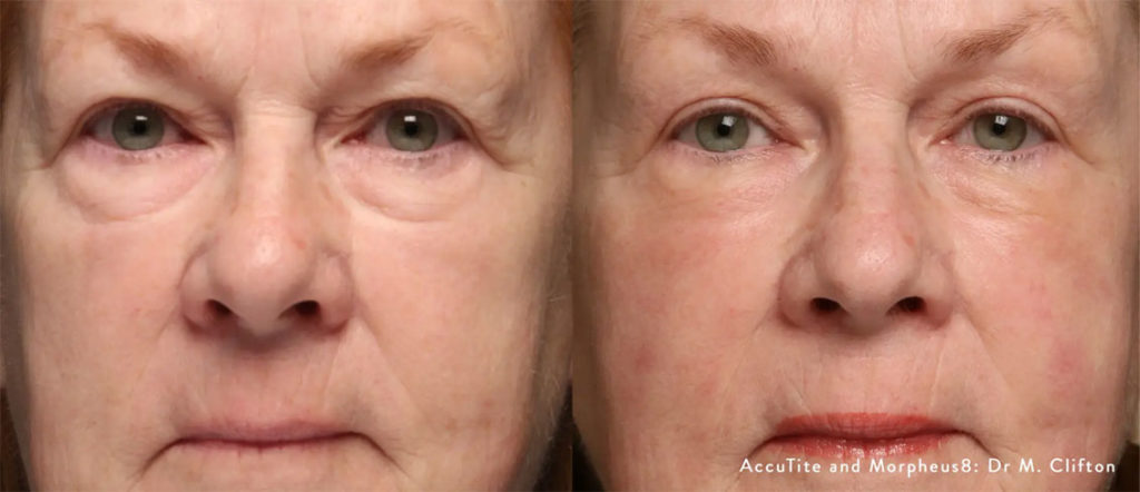 Morpheous8 before and after image
