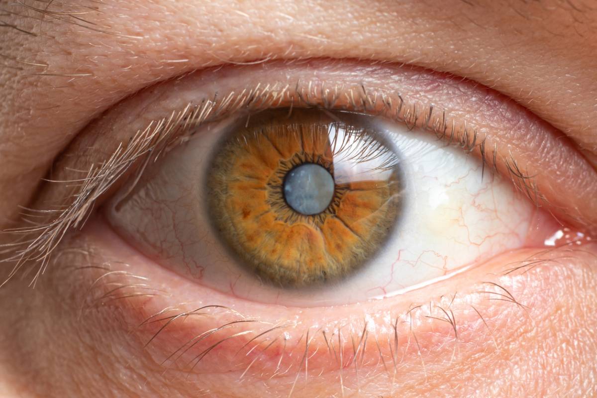 Concept image of cataracts after surgery