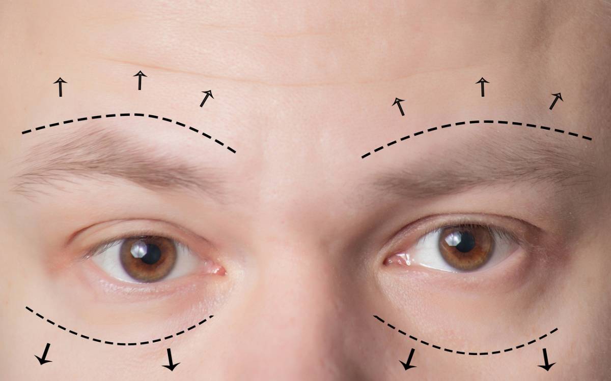 concept of the types of eyelid surgery