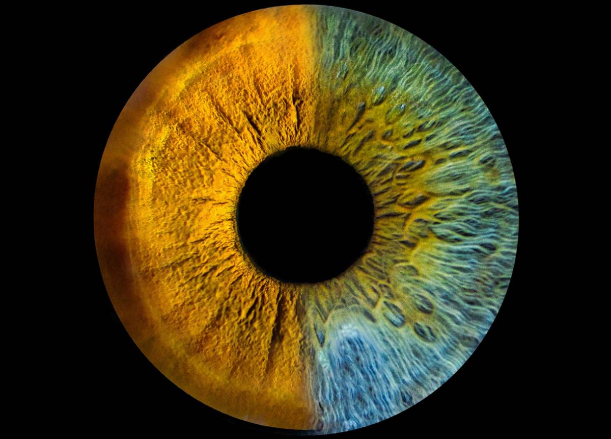 featured image for does lasik affect eye color