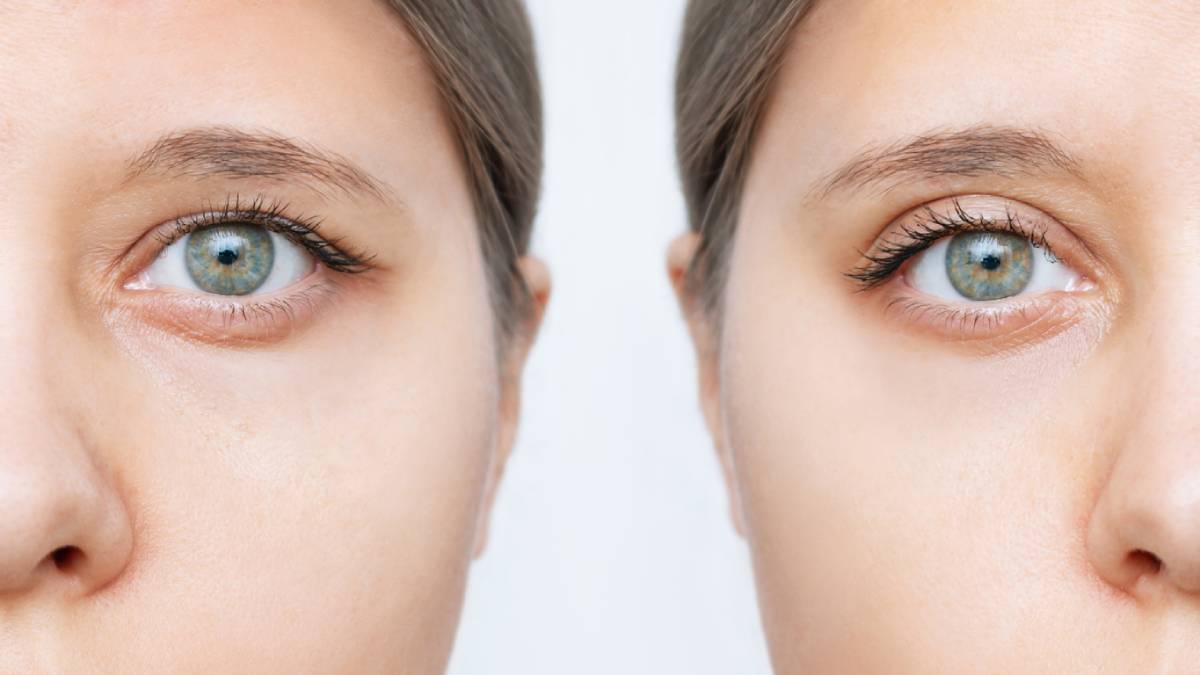 featured image for when does insurance cover eyelid surgery