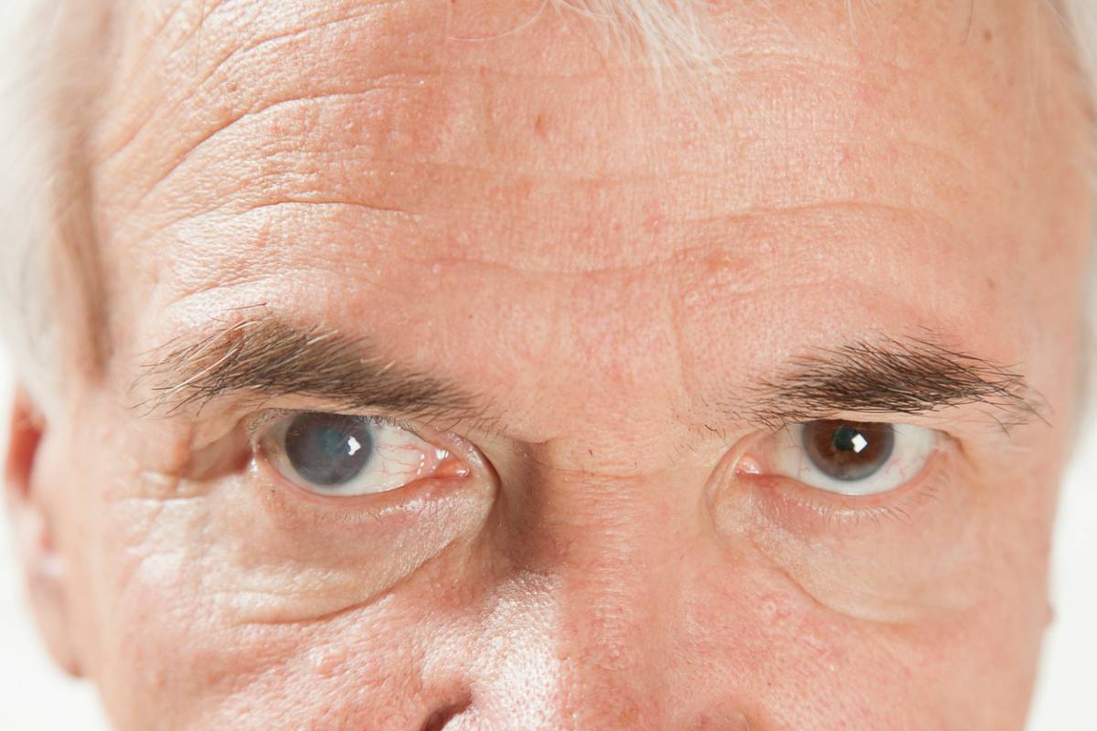 The purpose of this image is to show the appearance of cataracts in the eye and the top signs you have cataracts.